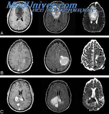 опухоли головного мозга