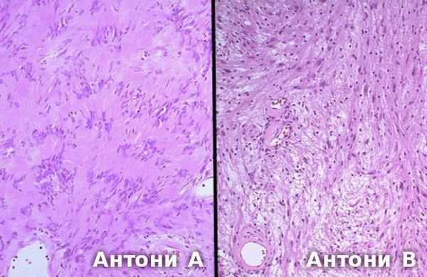 Гистологический препарат: слева тип Антони А, справа тип Антони В