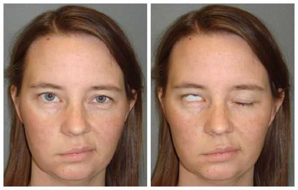 Паралич мимических мышц