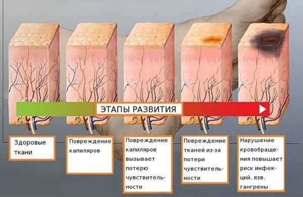 Диабетическая полинейропатия