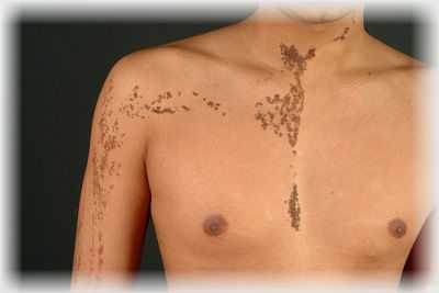 невус на груди