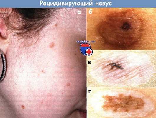 Невус рецидивирующий невомеланоцитарный