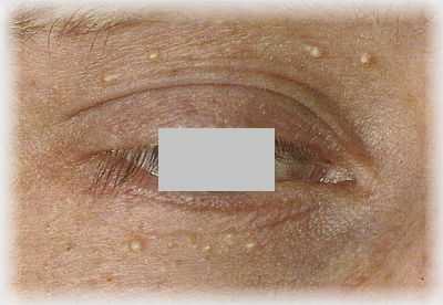 невус глаза