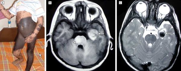 Нейрокожный меланоз