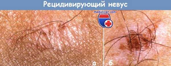 Невус рецидивирующий невомеланоцитарный