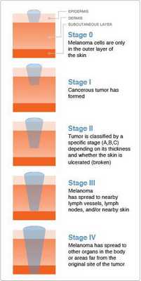 Стадии меланомы