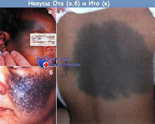 Невусы Ота и Ито