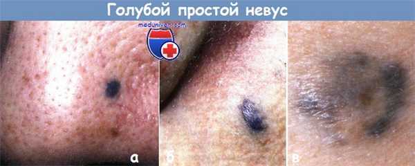 Голубой простой невус
