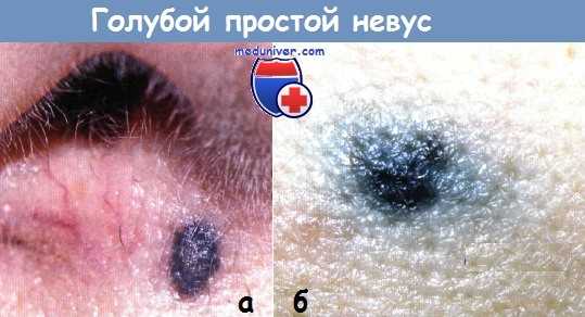 Голубой простой невус