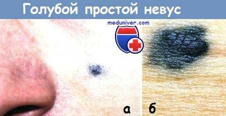 Голубой простой невус