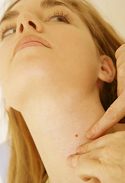 Диагностика невусов