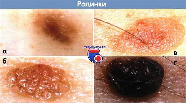 Дерматоскопия пограничного пигментного невуса