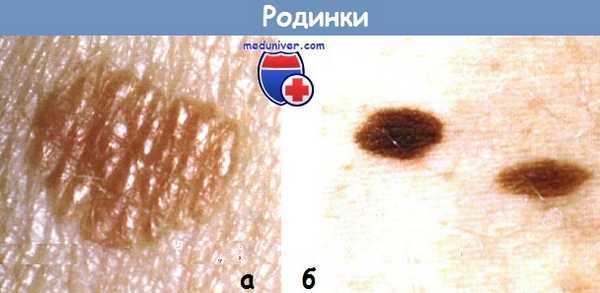 Пограничный пигментный невус может трансформироваться в меланому