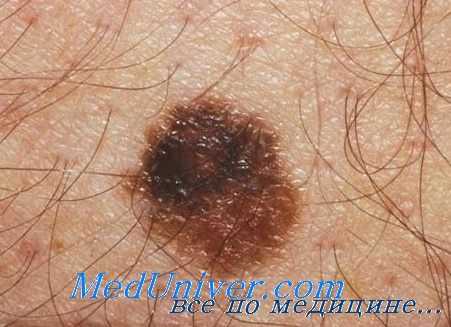 диспластический невус
