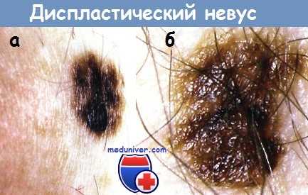 Диспластический невус