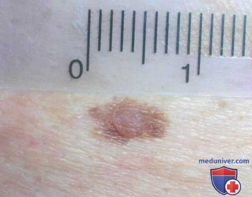 Диспластический невус