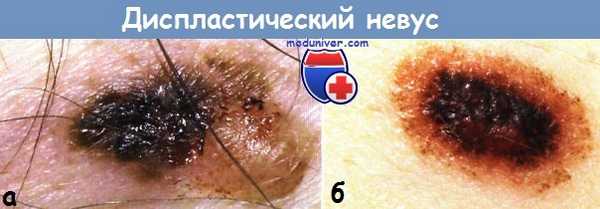 Диспластический невус