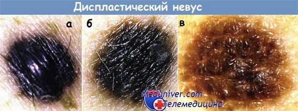 Диспластический невус