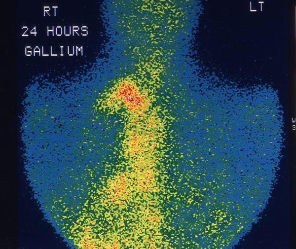 Неходжкинские лимфомы