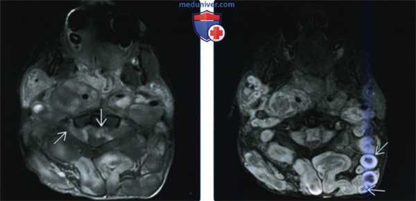 КТ, МРТ при нейрофиброматозе первого типа головы и шеи