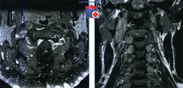 Нейрофиброма сонного пространства - лучевая диагностика