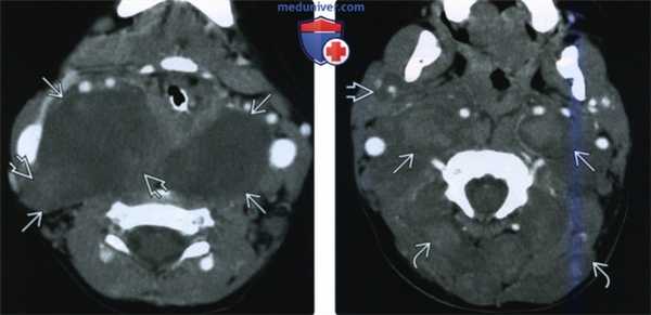 КТ, МРТ при нейрофиброматозе первого типа головы и шеи