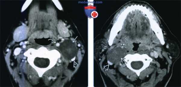 Нейрофиброма сонного пространства - лучевая диагностика