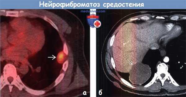 Нейрофиброматоз средостения на КТ, ПЭТ