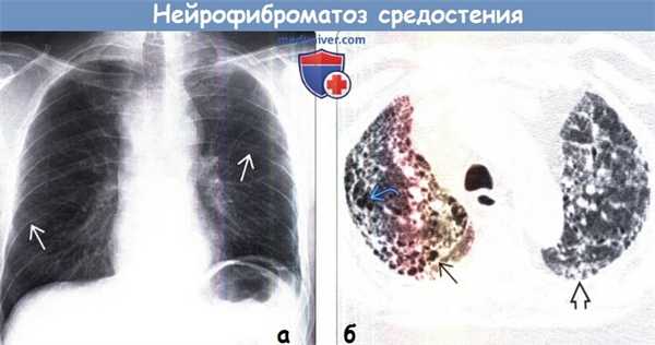 Нейрофиброматоз средостения на рентгенограмме