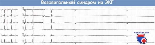 Нейрокардиогенные обмороки