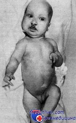 эктродактилия