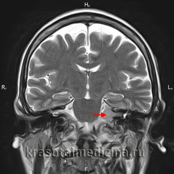 МРТ головного мозга. Невринома слухового нерва слева в области мосто-мозжечкового угла