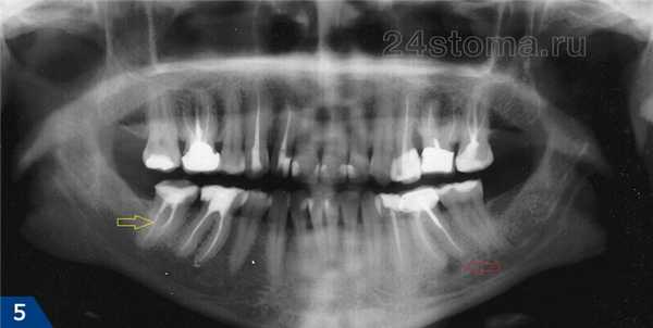 Пленочный панорамный снимок: как мы видим он очень нечеткий, особенно в области передних зубов. Желтой стрелкой отмечен вид запломбированных корневых каналов, а красной - затемнение у верхушки корня зуба (оно говорит о наличии кисты)