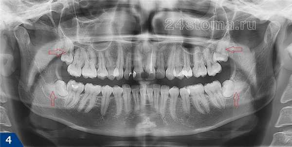 Цифровой панорамный снимок, сделанный для определения положения зубов мудрости (они указаны стрелками)
