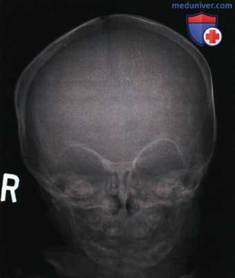Рентгенограмма черепа и нижней челюсти в ЗП или ПЗ проекции
