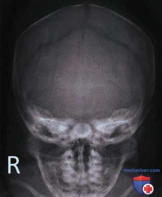 Рентгенограмма черепа и нижней челюсти в ЗП или ПЗ проекции
