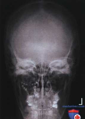 Рентгенограмма черепа и нижней челюсти в ЗП или ПЗ проекции