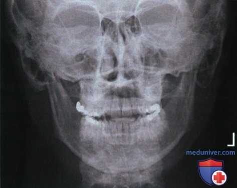 Рентгенограмма черепа и нижней челюсти в ЗП или ПЗ проекции