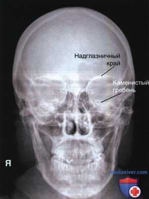 Рентгенограмма черепа и нижней челюсти в ЗП или ПЗ проекции