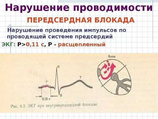 Нарушение проводимости сердца на ЭКГ