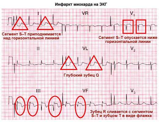Инфаркт миокарда
