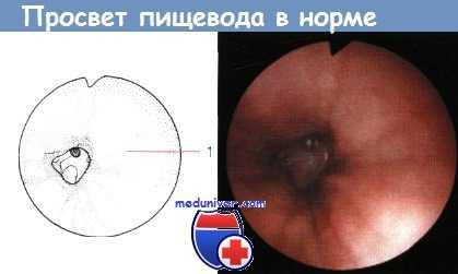 Просвет пищевода в норме