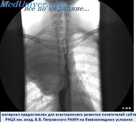 Эзофагография при раке легкого