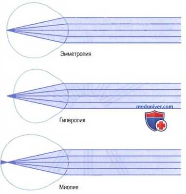 Нормальное зрение - эмметропия. Дальнозоркость и близорукость