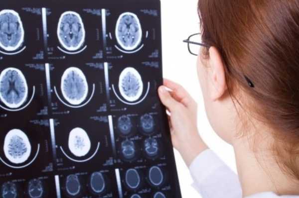 Как выглядит гидроцефалия на снимках МРТ