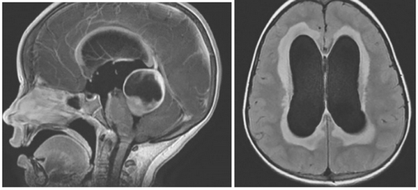 Гидроцефалия на МРТ