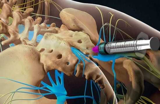 Блокада позвоночника при грыже