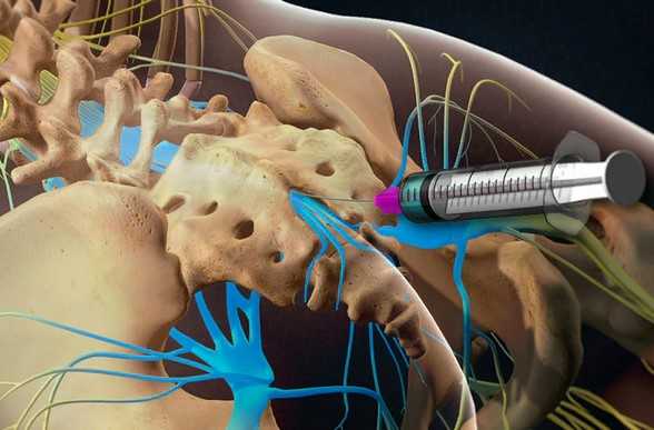 Новокаин накапливается в нервных тканях, не позволяет болевым импульсам распространяться по нервным волокнам