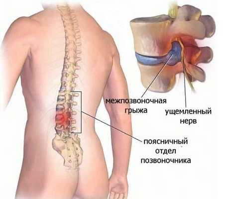 Симптомы грыжи грудного отдела позвоночника напоминают болезни сердца