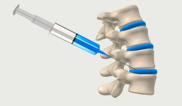 Новокаиновая блокада – показания и противопоказания